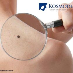 Leading Skin Tag Removal Clinic in Bangalore - Kosmoderma's Expert Care_11zon