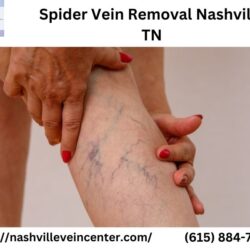 Spider Vein Removal Nashville TN