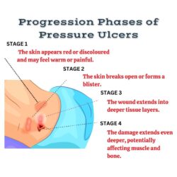 3. Progression phases of pressure ulcers