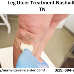 Leg Ulcer Treatment Nashville TN