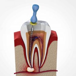root-canal-scaled (1)