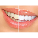 Teeth-Whitening-Park-dental-ptmwaxsu6utvy8l5o32fhl1q6e5k65fw5jinrzki1o